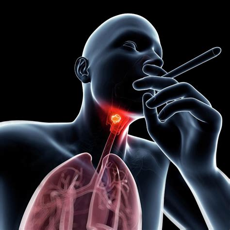 Pathophysiology Of Laryngeal Cancer