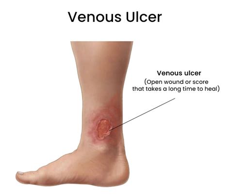 Venous Ulcers Treatment in Brooklyn, New York - Arterial Ulcers Specialist