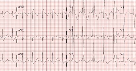 Emergency Notes: EKG myocardial contusion