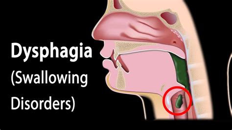 dysphagia – Enayati