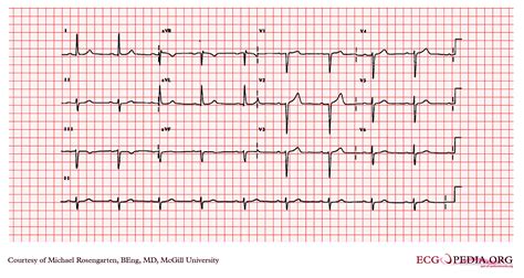 First degree AV block EKG examples - wikidoc