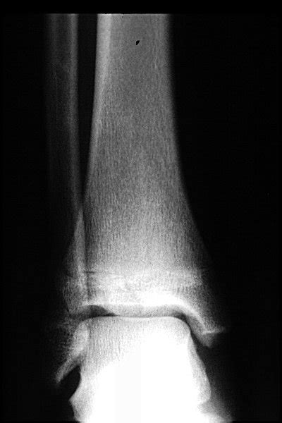 Musculoskeletal Radiology of Fractures