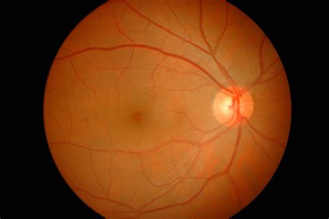 Fundus Photo Revision – e-Module Diabetic Retinopathy Screening Course