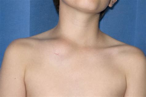 Clavicular swelling—classic presentation of chronic non-bacterial ...