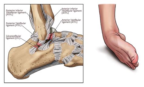 Right Ankle Sprain Anatomy