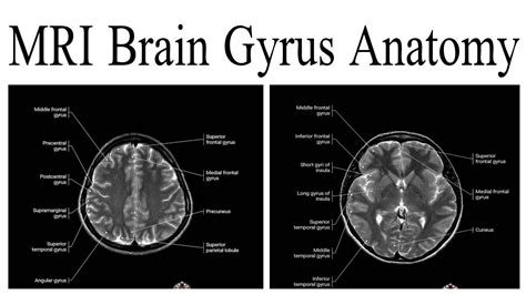 Superior Frontal Gyrus Mri