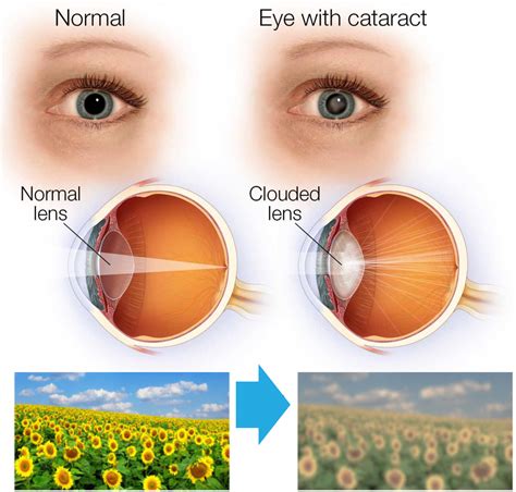 Glaucoma and Cataracts - Glaucoma Associates of Texas