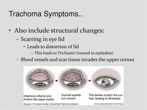 PPT - TRACHOMA PowerPoint Presentation, free download - ID:3029397