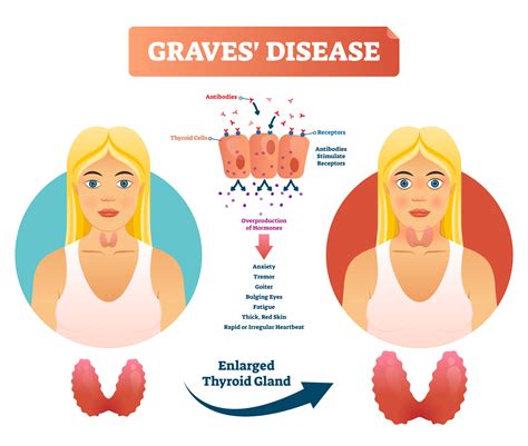 Swollen Thyroid Gland Symptoms