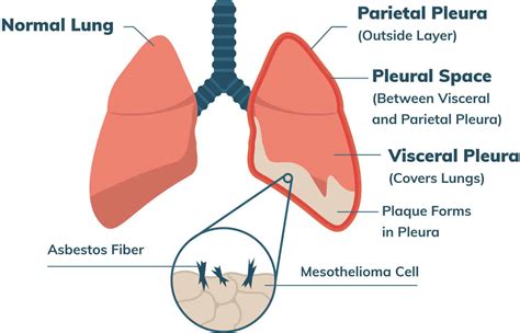 Malignant Mesothelioma Cancer | Stages, Prognosis, Treatment