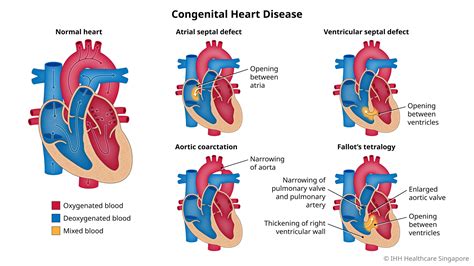 Congenital Heart Defects Symptoms