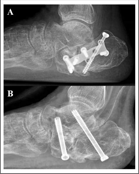 Rotational Osteotomy and Subtalar Arthrodesis for Subtalar Arthritis ...