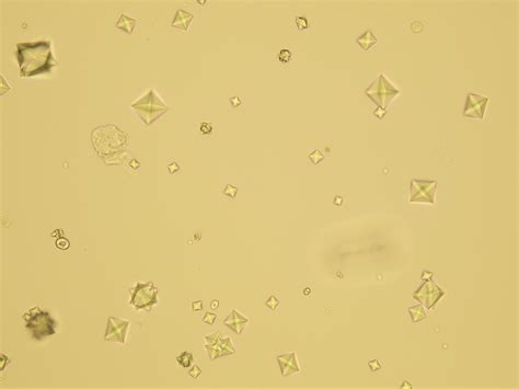 Calcium Oxalate Dihydrate Crystals In Urine