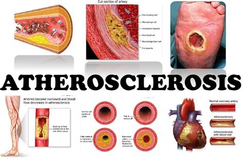 Pathway Atherosclerosis