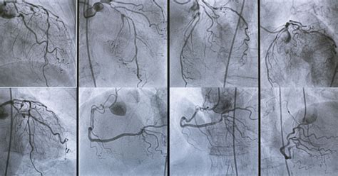 Coronary Angiography Procedure