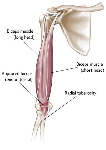 Biceps Tendon Tear at the Elbow - OrthoInfo - AAOS