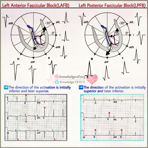 Figure: Left anterior fascicular block... - Knowledge Of ECG