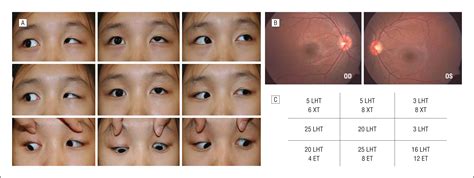 Anterior and Nasal Transposition of the Inferior Oblique Muscle for ...