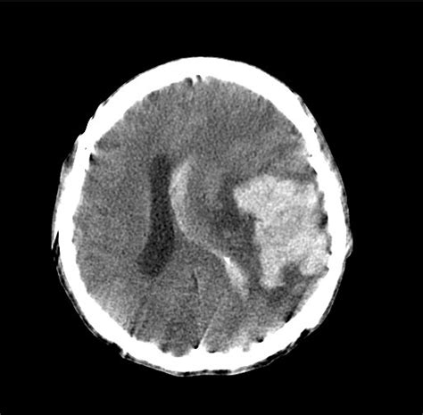 Brain Bleed On Ct Scan