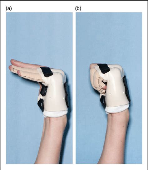 Proximal Phalanx Fracture Splint