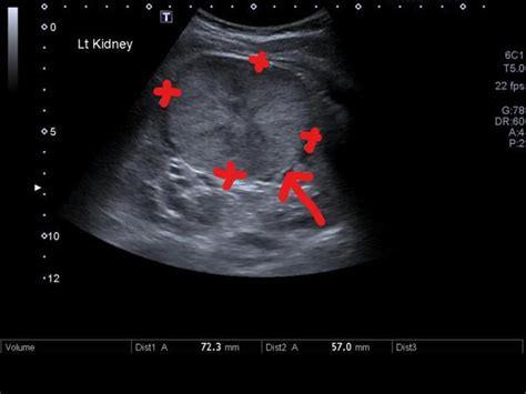 Renal oncocytoma ultrasound - wikidoc