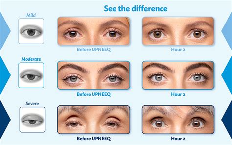 Droopy Eyelids: Causes, Treatments, Risks & More | Howard Ossen,Od