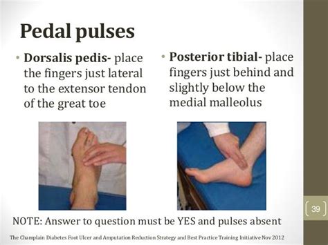 How To Find Pedal Pulse On Foot