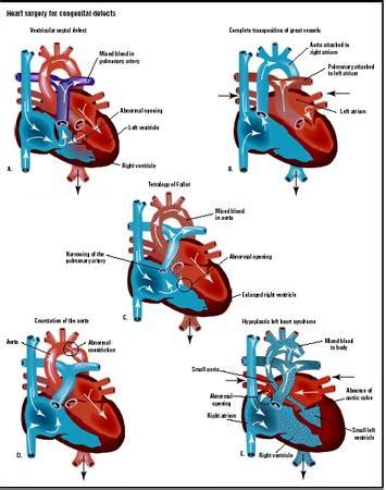 Heart Surgery for Congenital Defects - procedure, blood, tube, pain ...