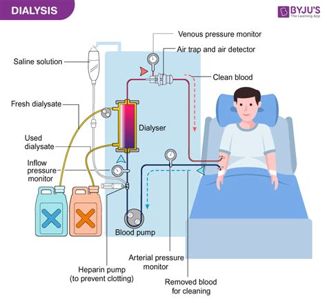 why salt solution is used for dialysis - Jennifer Tucker