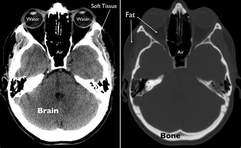 Exploring the Brain: How Are Brain Images Made with CT? | UCSF Radiology