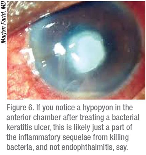 Corneal Ulcer Treatment Eye Drops