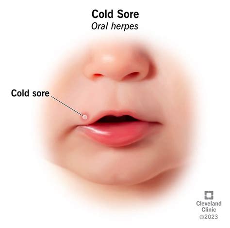 Cold Sore: Causes, Treatment & Prevention