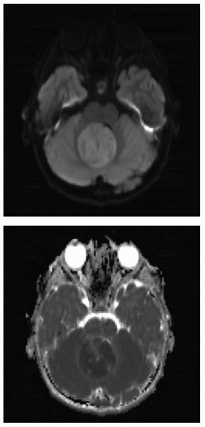 Brain Tumors | Radiology Key