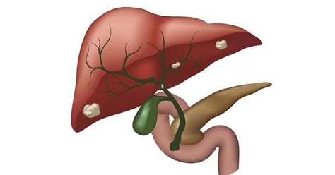 Cholangiocarcinoma: Symptoms, Types, Causes, Diagnosis, Treatment ...