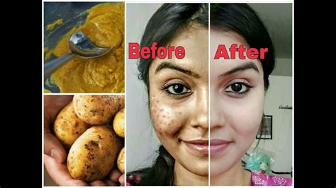 How To Remove Dark Spots On Face Home Remedies