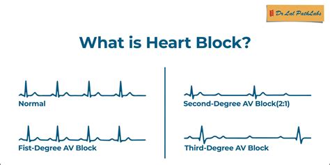 Heart Block: Symptoms and Diagnosis | Dr Lal PathLabs Blogs