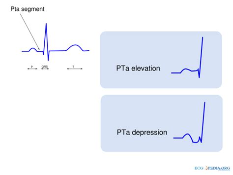 P Wave Morphology - ECGpedia