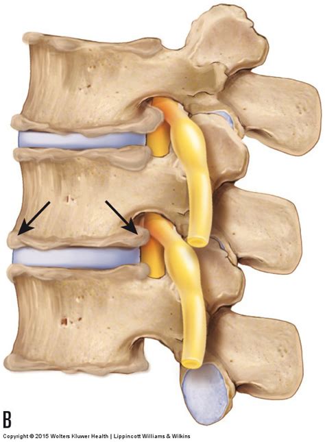 Facet Degenerative Joint Disease - Captions Pages