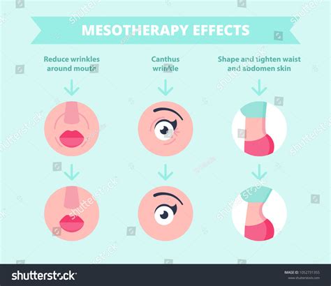 Meso Therapy Before After: Over 11 Royalty-Free Licensable Stock ...