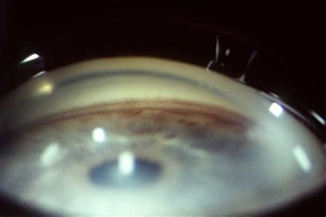 Angle Recession Glaucoma: case study, diagnosis and management