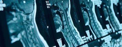 Abnormal Cervical Spine Mri