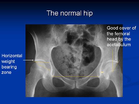 Hip Dysplasia1 - Hip Joint Surgery