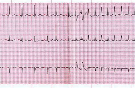 Ecg Abnormalities Examples