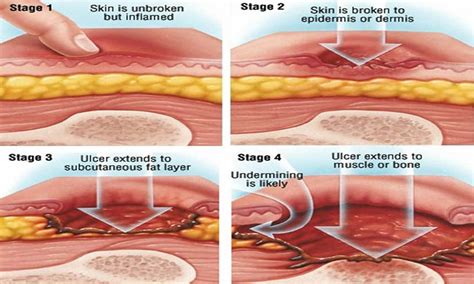 Bed sores, pressure ulcer causes, stages, prevention & pressure ulcer ...