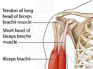 Displaced Biceps Tendon & Shoulder Pain