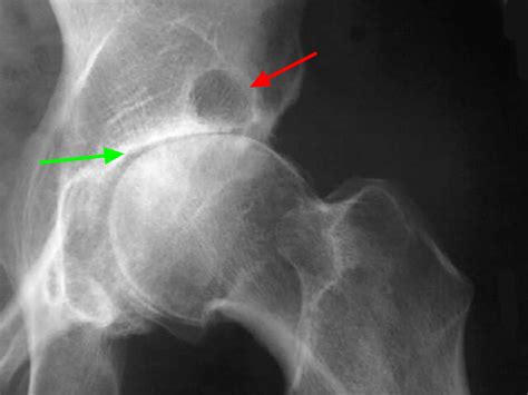 Osteoarthritis - Causes, Symptoms, Diagnosis, Prognosis & Treatment