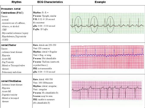 Pin by Nicole Bedoya on Nursing | Acls, Nursing notes, Acls study