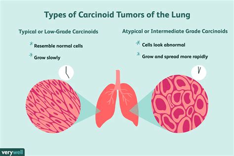 Carcinoid Syndrome: Symptoms, Causes, Diagnosis, and Treatment