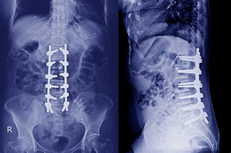 Lumbar Spine Degeneration