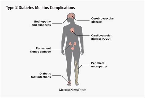 Potential complications of type 2 diabetes